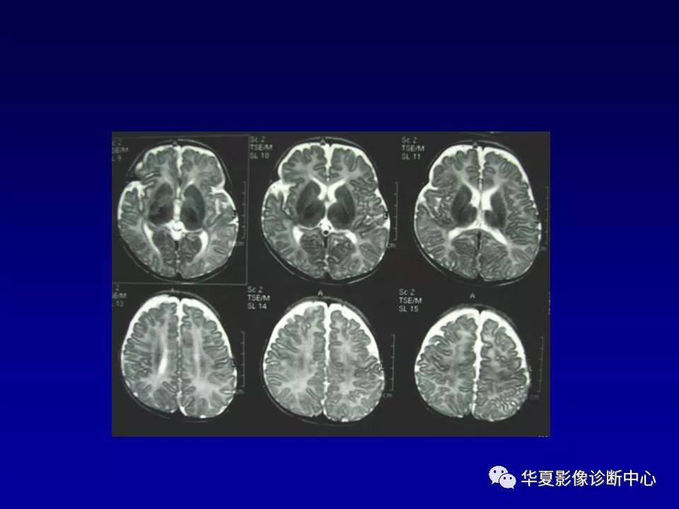 新生儿脑室周围白质软化的影像学特点