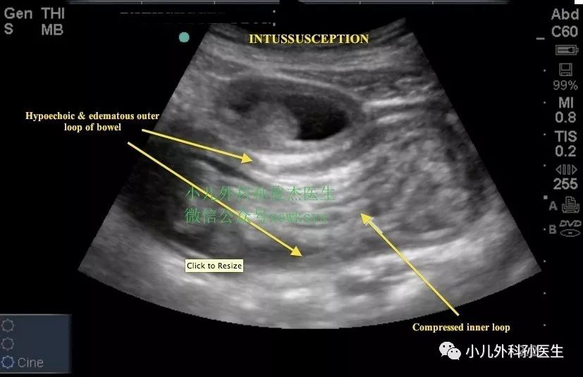 小儿肠套叠的超声图谱图片