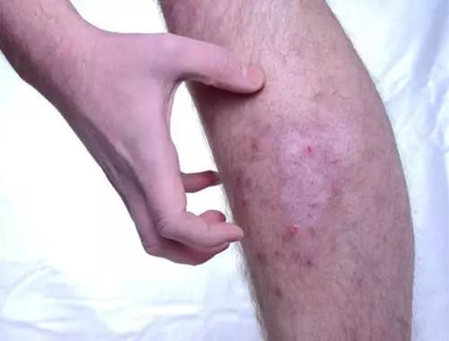 从而引起四肢末梢部位的皮肤出现异常,如有蚁走感,麻木感,瘙痒感等