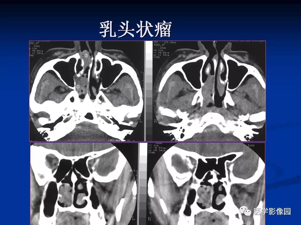 鼻腔鼻竇良惡性腫瘤的ctmr診斷一影像天地