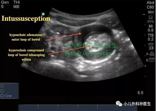 小儿肠套叠的超声图谱图片
