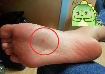蚊子咬脚心图片