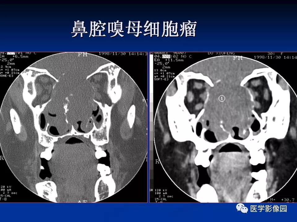 鼻腔鼻窦良恶性肿瘤的ctmr诊断二影像天地