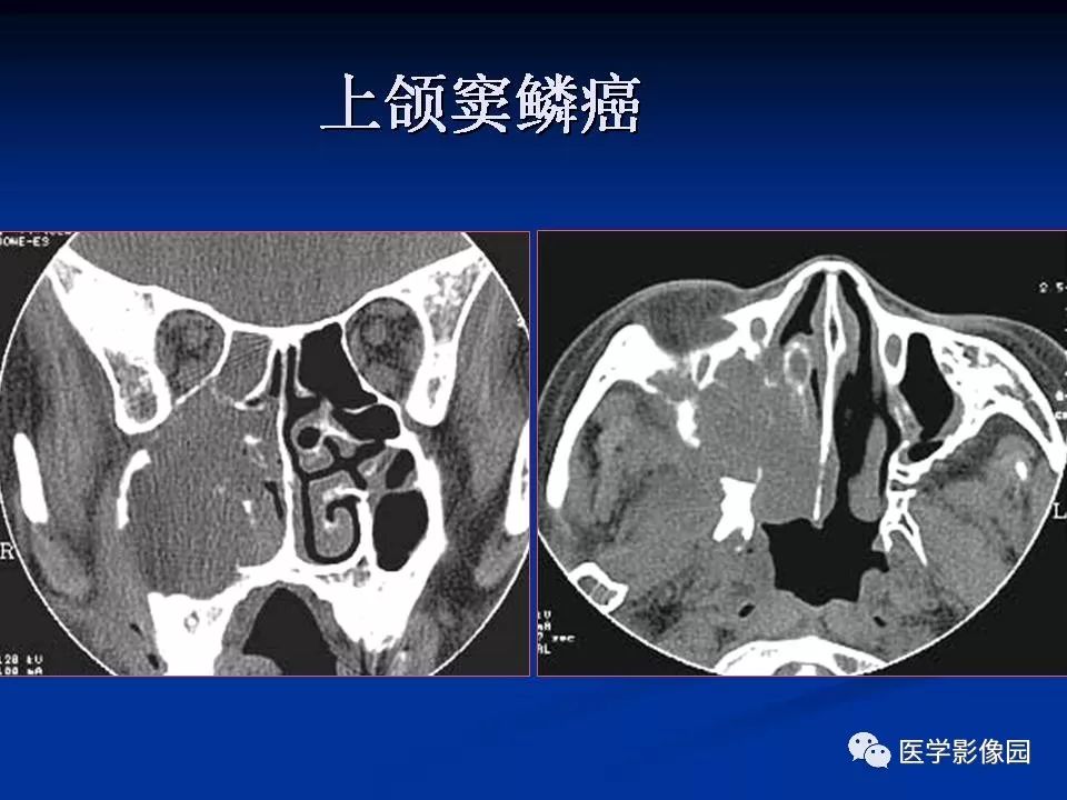 鼻腔鼻竇良惡性腫瘤的ctmr診斷二影像天地