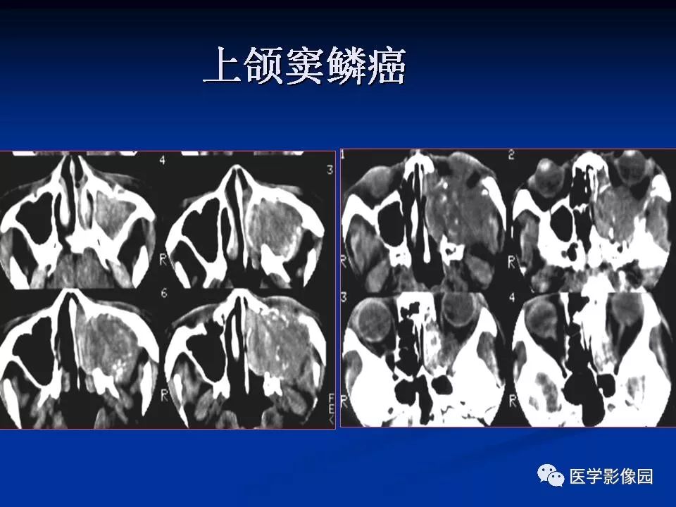 鼻腔鼻竇良惡性腫瘤的ctmr診斷二影像天地