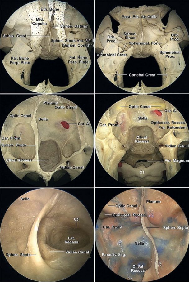 脊索瘤和軟骨肉瘤手術策略與技巧theneurosurgicalatlas全文翻譯