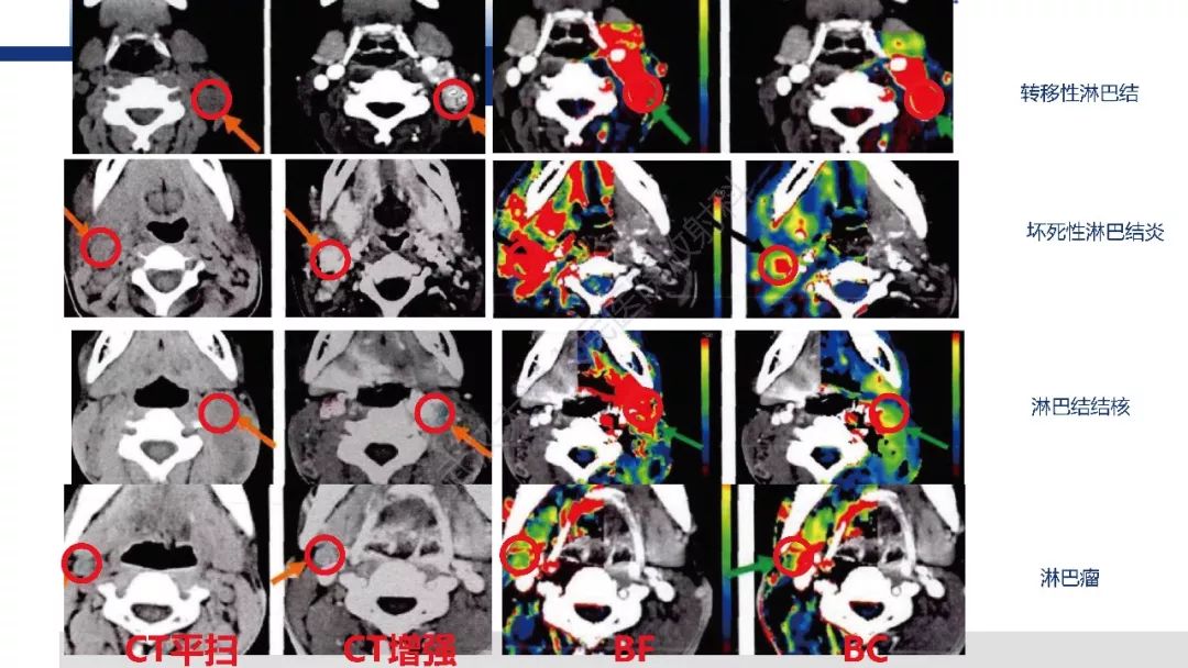 颈部良恶性淋巴结影像学鉴别