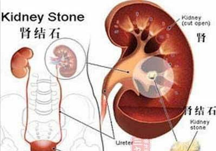 如果肾结石犯了,到底有多痛?今天可算知道了