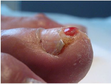 指甲纤维瘤图片