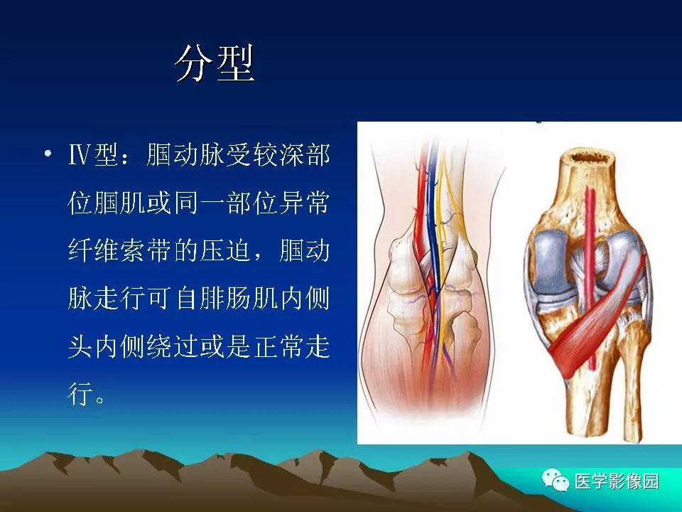 腘动脉陷迫综合征影像学诊断影像天地