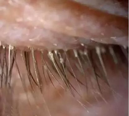 将出现2条蠕动的虫子这是一只在睫毛根部开心蠕动的螨虫眼睛经常痒,你