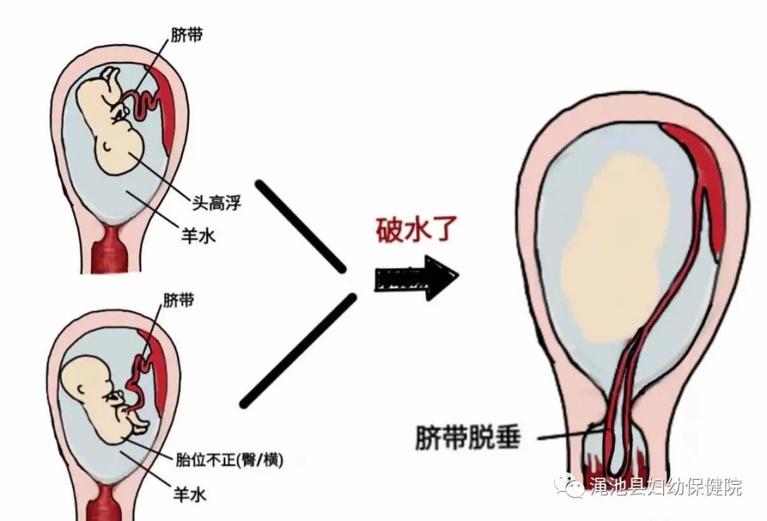 母婴健康破水到底啥感觉