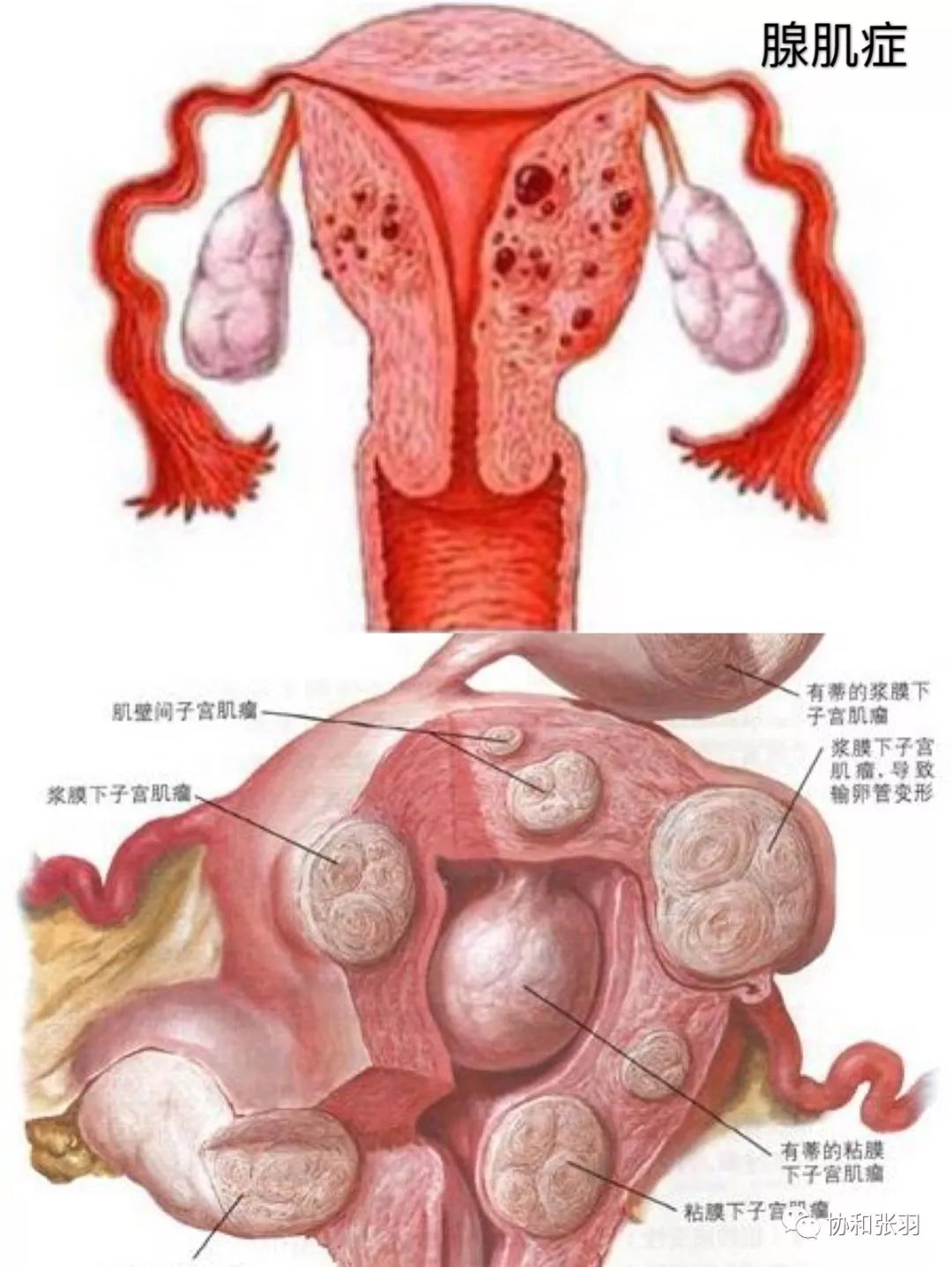 子宫腺肌症会自愈吗文章摘要:子宫腺肌症属于妇科常见病和疑难病,其