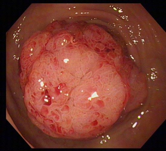 李博主治医师为该患者进行了结肠镜检查,在乙状结肠见一大小约4×3cm