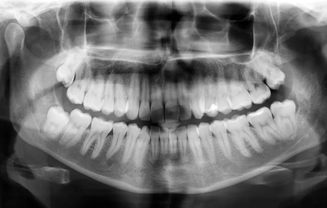 牙科x光片拍摄角度图片