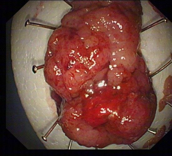 冠縣中心醫院消化內科成功對巨大結腸腺瘤並高級別瘤變02患者行結腸