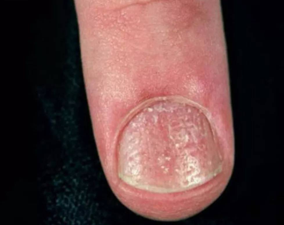 儿童银屑病指甲图片图片