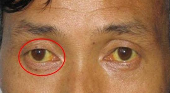 血液中的血红球被破坏,胆红素因代谢不完全,使毒素残留在眼睛巩膜上