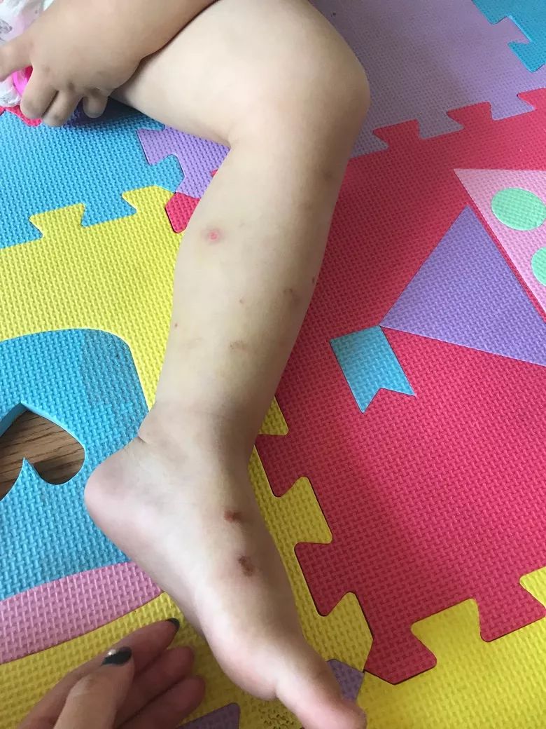 小孩被蟑螂咬伤图片图片