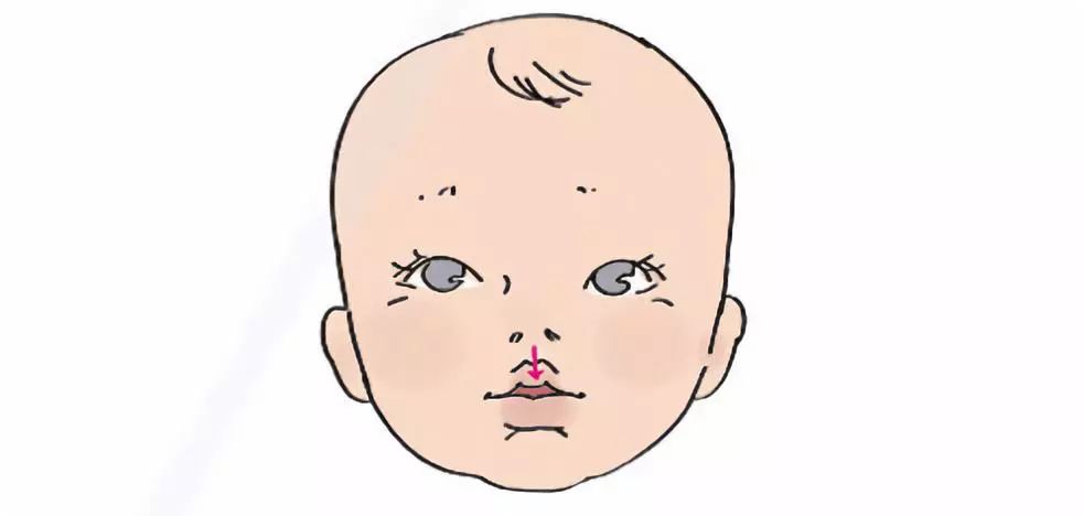 婴儿高腭弓嘴型图片图片