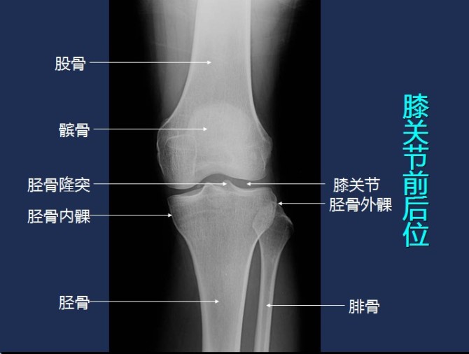 膝关节侧位片解剖图片
