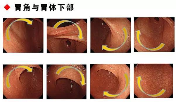 如何在胃镜下发现早期胃癌?