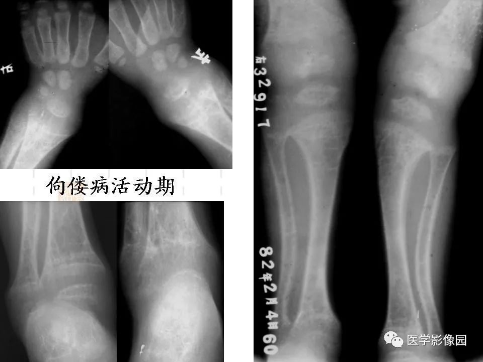 佝偻病的图片x片图片