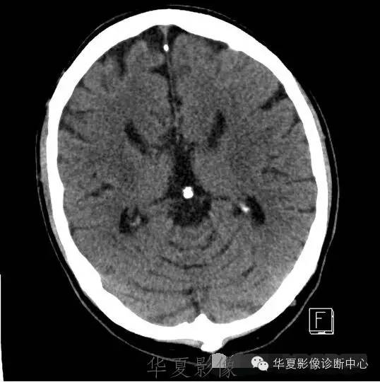 8种颅脑先天畸形ct诊断