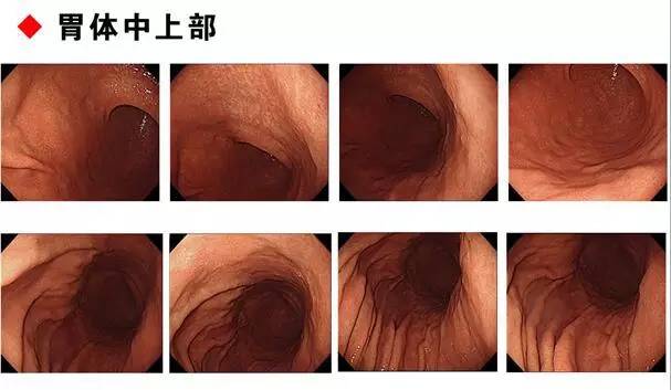 胃癌图片实拍 症状图片