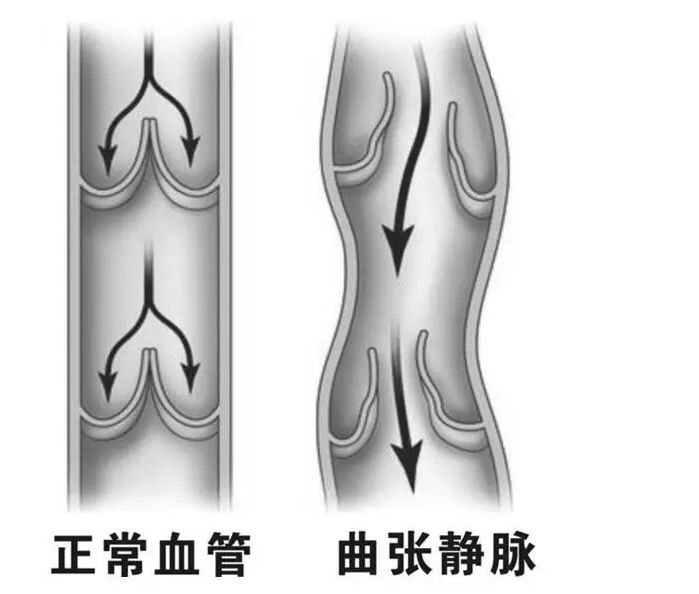 哪些人易得蚯蚓腿?有关静脉曲张的8个疑问