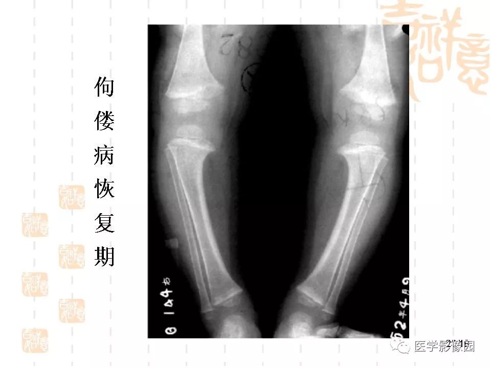 佝偻病的图片x片图片