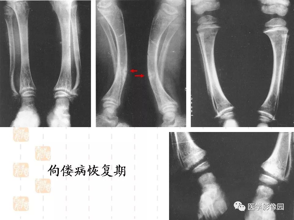 佝偻病的图片x片图片