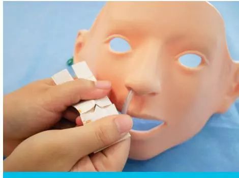 鼻肠管固定方法图片图片