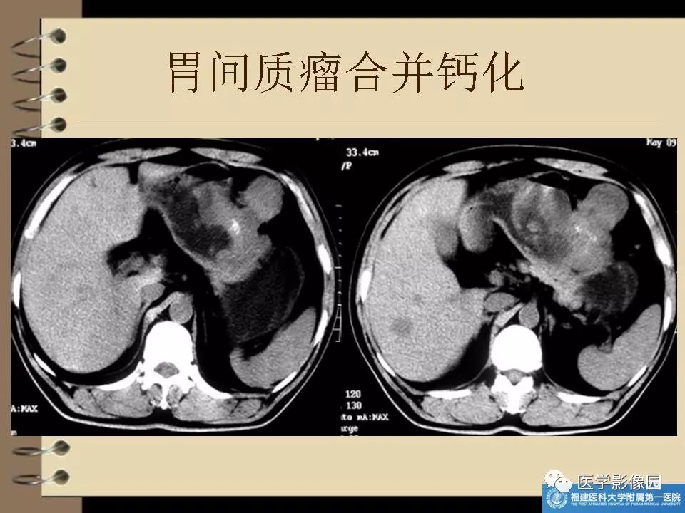 胃間質瘤的ct診斷與鑑別診斷影像天地