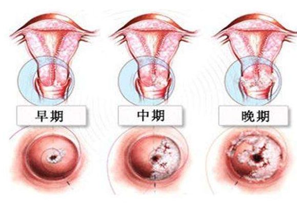 感染女性生殖道的hpv有四十多种,其中约15种可导致宫颈癌