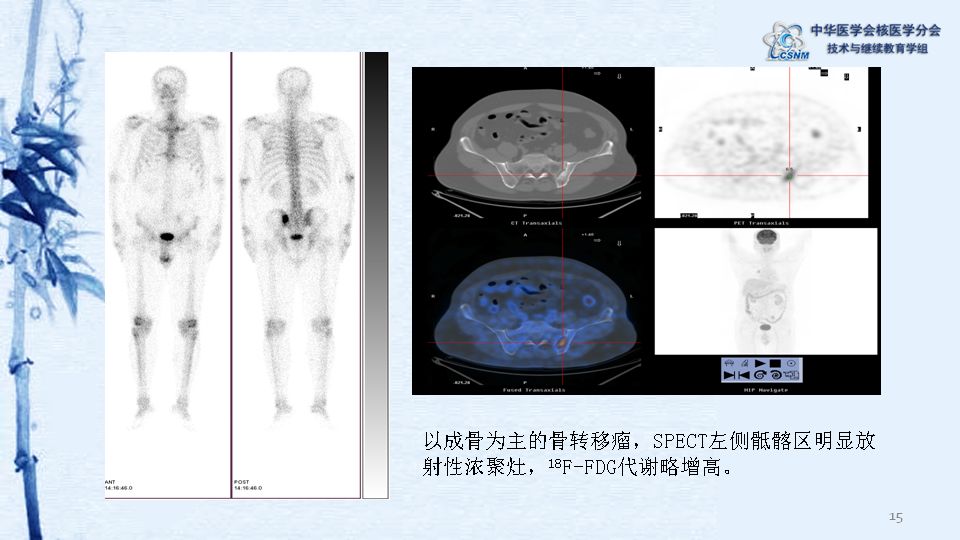 講座08期徐微娜petct與spect診斷骨轉移瘤的對比分析