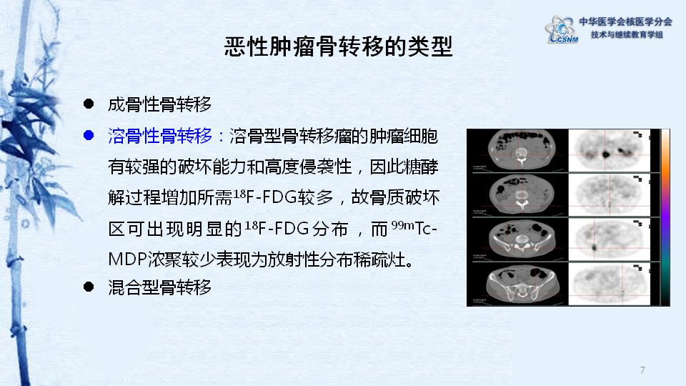 講座08期徐微娜petct與spect診斷骨轉移瘤的對比分析