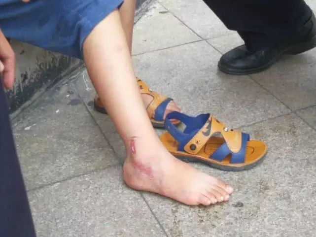 漳州一小男孩脚卡车轮伤势见骨,惨痛哭声引来民警