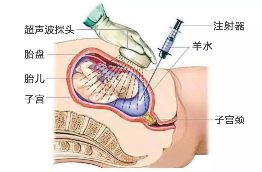 羊水穿刺可能流产?无创dna检查仍生出畸形儿?孕妈到底该咋选?