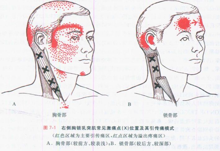 胸锁乳突肌疼图片