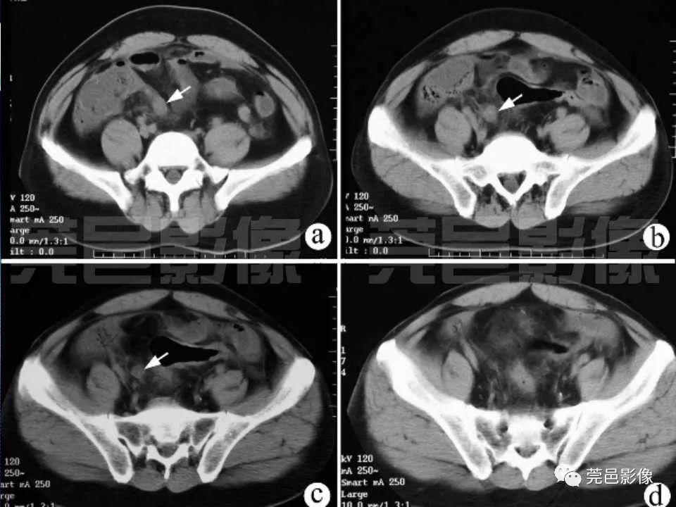 急性阑尾炎ct表现图片图片