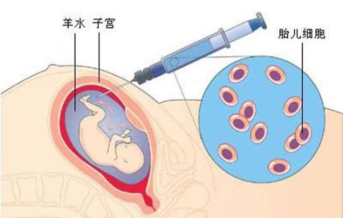 羊水穿刺雖有風險,但這5類準媽媽一定要做!