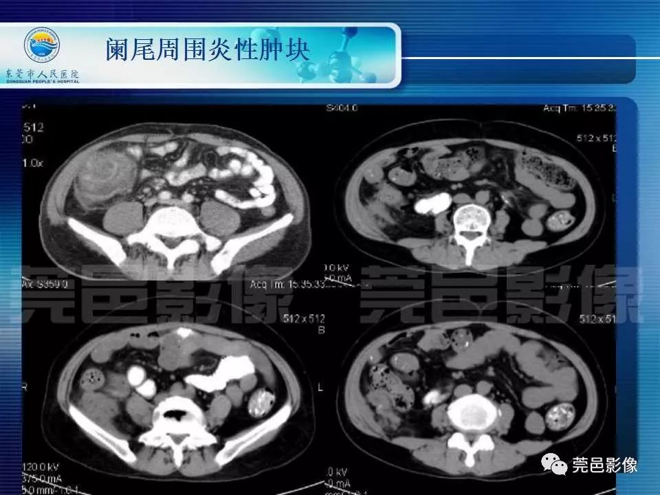 急性阑尾炎CT图片图片