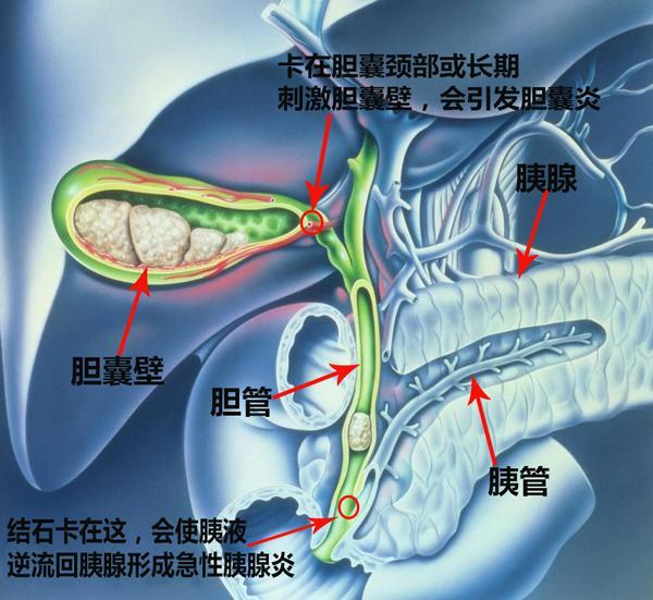 胆总管结石图解图片