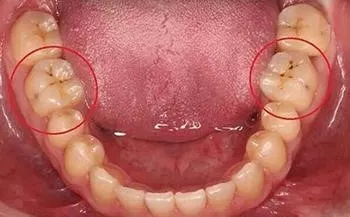牙齿有黑线是什么原因图片