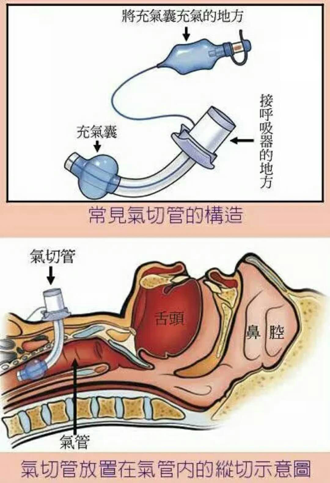 气管切开术解剖图图片