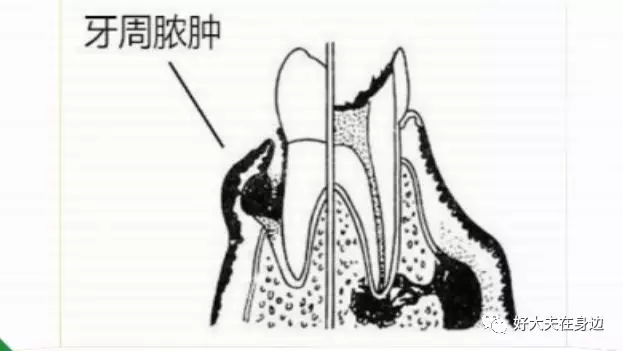 引起牙齦腫痛的原因主要包括牙齦膿腫,牙周膿腫,智齒冠周炎或根尖周炎