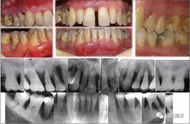 牙周炎症状图片及治疗图片