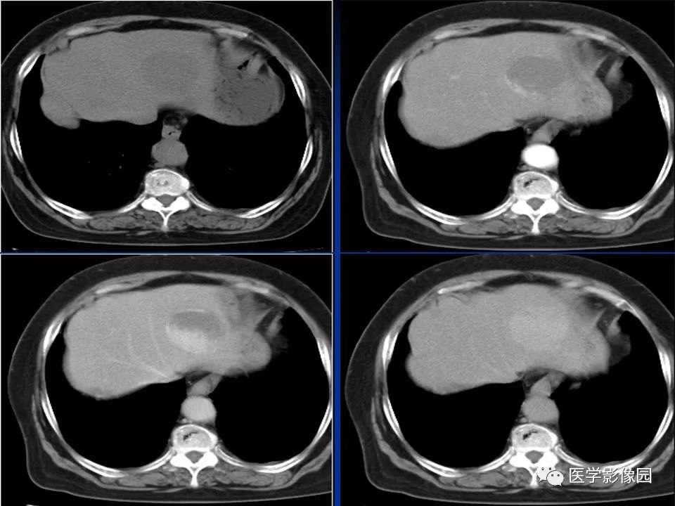 肝脏血管瘤影像学表现及鉴别诊断二影像天地
