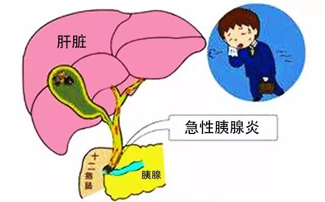 大鱼大肉小心胰腺炎来敲门